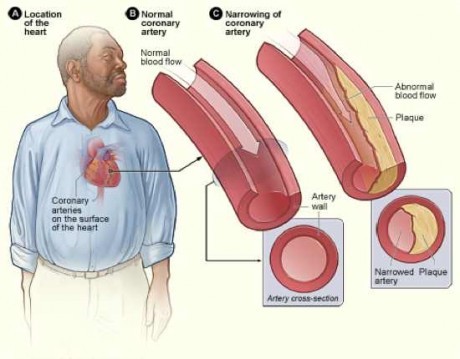 করোনারি আর্টারী রোগ (Coronary Artery Disease) 